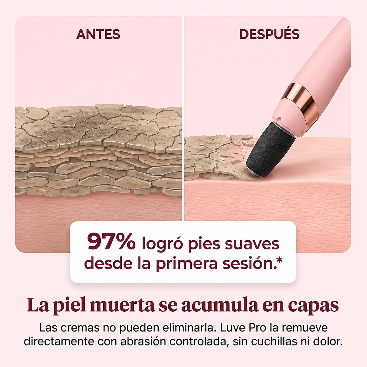 Luve™ PRO - Removedor de callos
