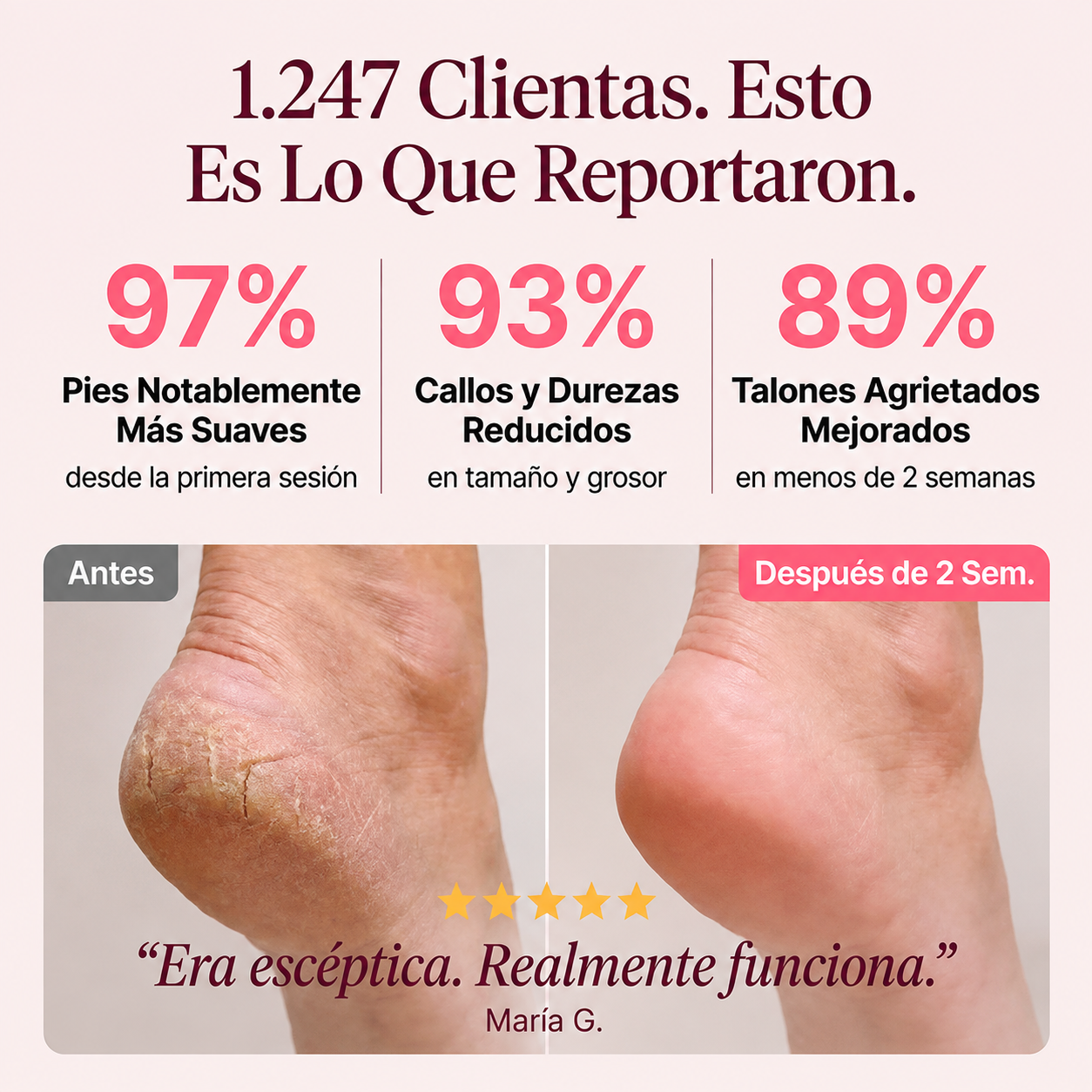 Luve™ PRO - Removedor de callos