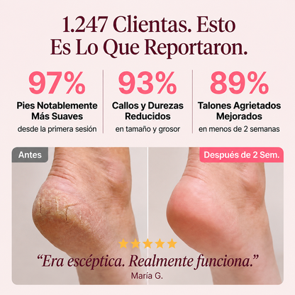 Luve™ PRO - Removedor de callos