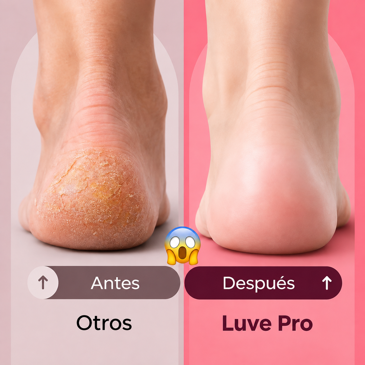Luve™ PRO - Removedor de callos